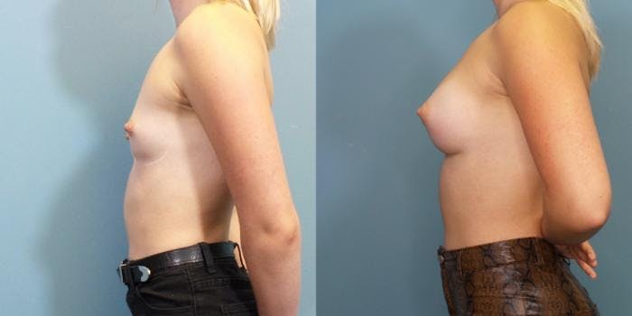 Breast Augmentation Before & After Gallery - Patient 342260 - Image 3