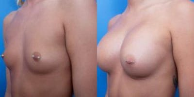 Breast Augmentation Before & After Gallery - Patient 357405 - Image 2