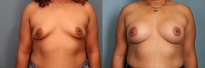 Breast Augmentation Before & After Gallery - Patient 128014 - Image 1