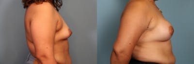 Breast Augmentation Before & After Gallery - Patient 128014 - Image 2