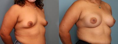 Breast Augmentation Before & After Gallery - Patient 128014 - Image 3