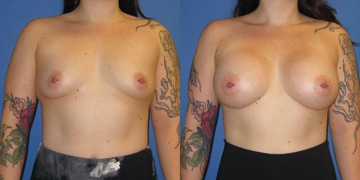 Breast Augmentation Before & After Gallery - Patient 416665 - Image 1