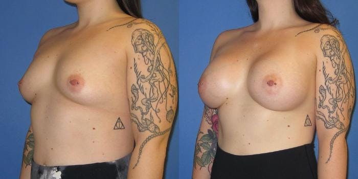 Breast Augmentation Before & After Gallery - Patient 416665 - Image 2
