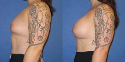 Breast Augmentation Before & After Gallery - Patient 416665 - Image 3