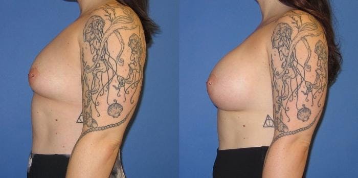 Breast Augmentation Before & After Gallery - Patient 416665 - Image 3