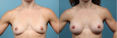 Breast Augmentation Before & After Gallery - Patient 752450 - Image 1