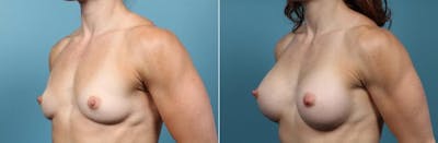 Breast Augmentation Before & After Gallery - Patient 752450 - Image 2