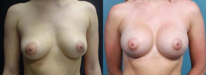 Breast Augmentation Before & After Gallery - Patient 270682 - Image 1