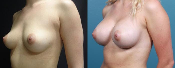 Breast Augmentation Before & After Gallery - Patient 270682 - Image 2
