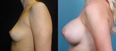 Breast Augmentation Before & After Gallery - Patient 270682 - Image 3