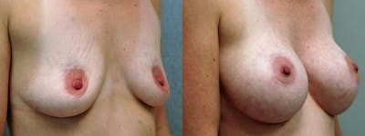 Breast Augmentation Before & After Gallery - Patient 309527 - Image 2