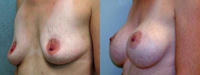 Breast Augmentation Before & After Gallery - Patient 309527 - Image 3