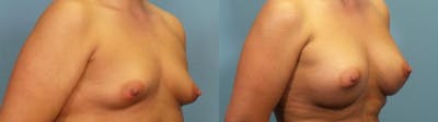 Breast Augmentation Before & After Gallery - Patient 405395 - Image 2
