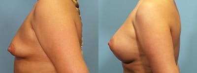 Breast Augmentation Before & After Gallery - Patient 405395 - Image 3