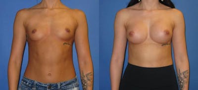 Breast Augmentation Before & After Gallery - Patient 407365 - Image 1