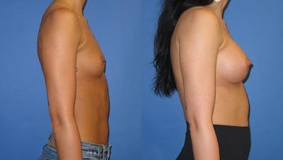 Breast Augmentation Before & After Gallery - Patient 407365 - Image 3