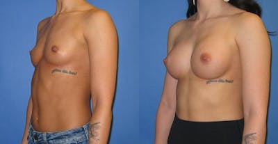 Breast Augmentation Before & After Gallery - Patient 407365 - Image 4