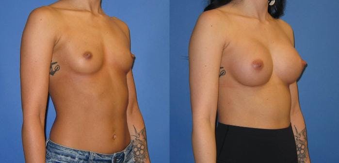 Breast Augmentation Before & After Gallery - Patient 407365 - Image 5