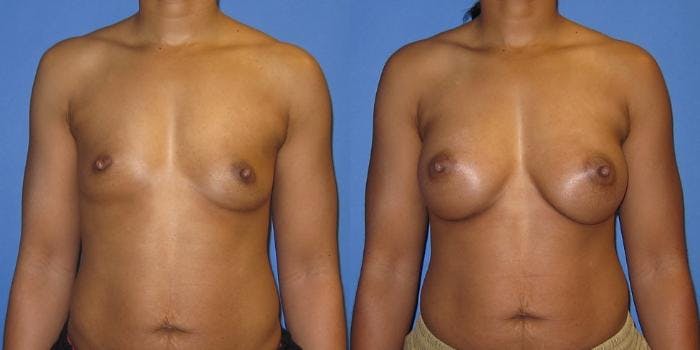 Breast Augmentation Before & After Gallery - Patient 606898 - Image 1