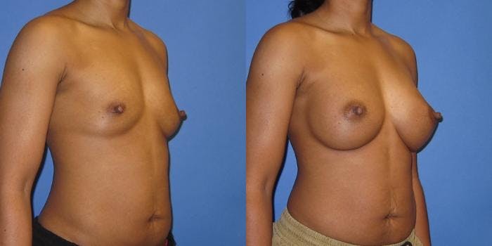 Breast Augmentation Before & After Gallery - Patient 606898 - Image 2