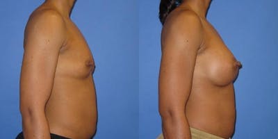 Breast Augmentation Before & After Gallery - Patient 606898 - Image 3