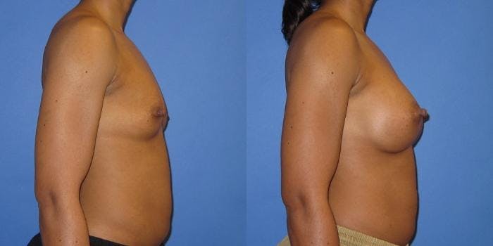 Breast Augmentation Before & After Gallery - Patient 606898 - Image 3