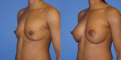 Breast Augmentation Before & After Gallery - Patient 606898 - Image 4