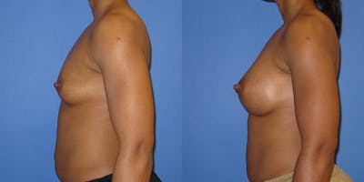 Breast Augmentation Before & After Gallery - Patient 606898 - Image 5
