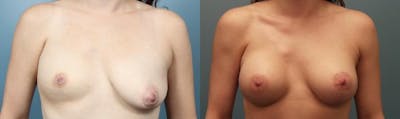 Breast Augmentation Before & After Gallery - Patient 146267 - Image 1