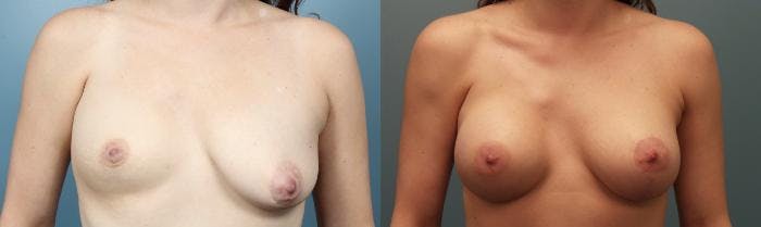 Breast Augmentation Before & After Gallery - Patient 146267 - Image 1