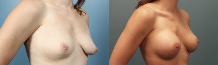 Breast Augmentation Before & After Gallery - Patient 146267 - Image 2