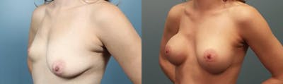 Breast Augmentation Before & After Gallery - Patient 146267 - Image 3