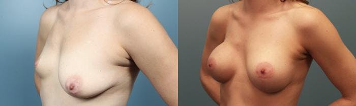 Breast Augmentation Before & After Gallery - Patient 146267 - Image 3