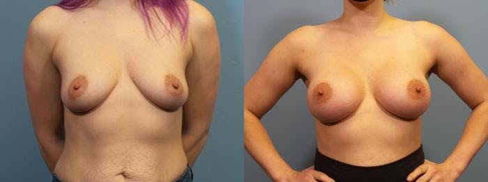 Breast Augmentation Before & After Gallery - Patient 223826 - Image 1