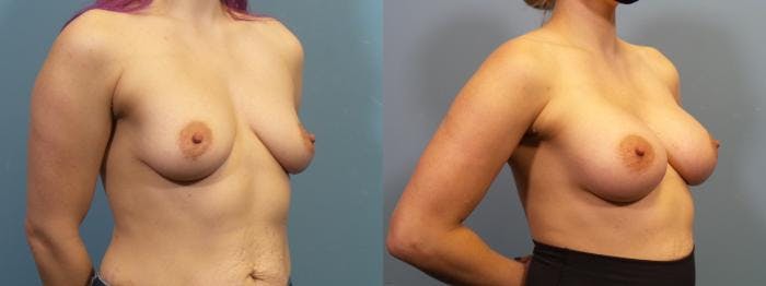 Breast Augmentation Before & After Gallery - Patient 223826 - Image 2
