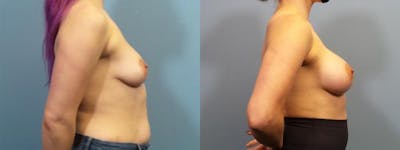 Breast Augmentation Before & After Gallery - Patient 223826 - Image 3