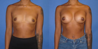 Breast Augmentation Before & After Gallery - Patient 234348 - Image 1