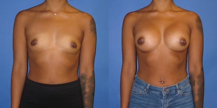 Breast Augmentation Before & After Gallery - Patient 234348 - Image 1