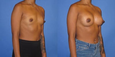 Breast Augmentation Before & After Gallery - Patient 234348 - Image 2