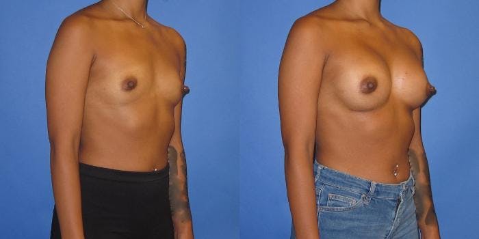 Breast Augmentation Before & After Gallery - Patient 234348 - Image 2