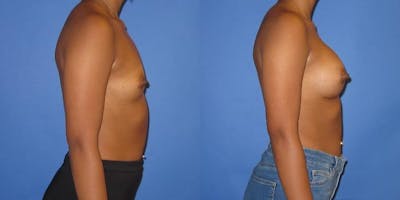 Breast Augmentation Before & After Gallery - Patient 234348 - Image 3
