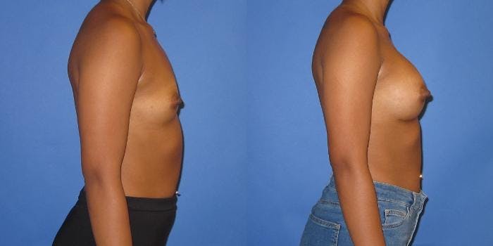 Breast Augmentation Before & After Gallery - Patient 234348 - Image 3