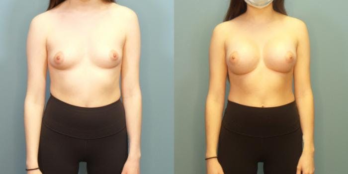 Breast Augmentation Before & After Gallery - Patient 254668 - Image 1
