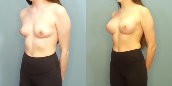 Breast Augmentation Before & After Gallery - Patient 254668 - Image 2