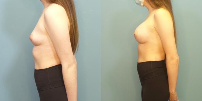 Breast Augmentation Before & After Gallery - Patient 254668 - Image 3