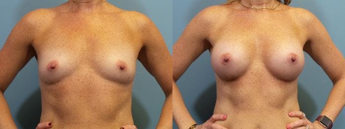 Breast Augmentation Before & After Gallery - Patient 356142 - Image 1