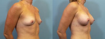 Breast Augmentation Before & After Gallery - Patient 356142 - Image 2