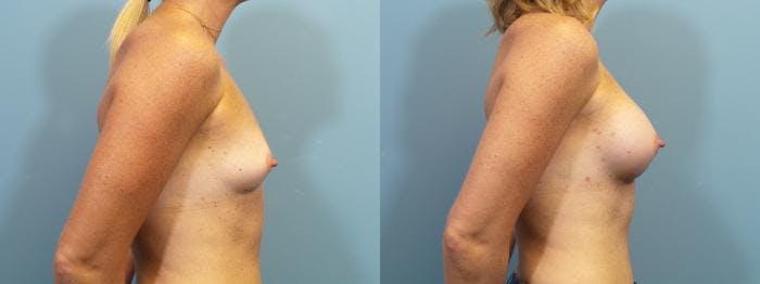 Breast Augmentation Before & After Gallery - Patient 356142 - Image 3