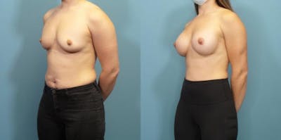 Breast Augmentation Before & After Gallery - Patient 113305 - Image 1