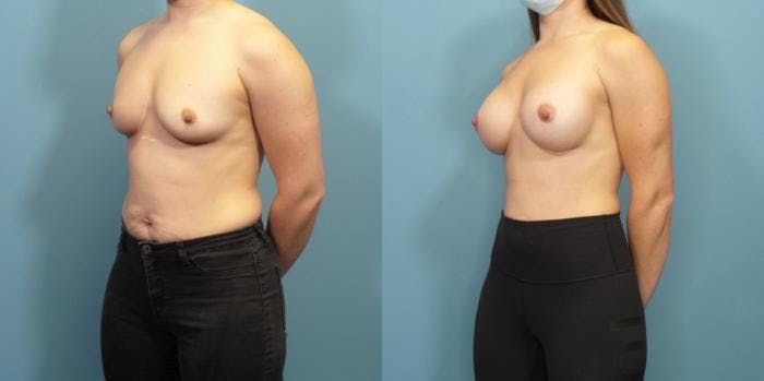 Breast Augmentation Before & After Gallery - Patient 113305 - Image 1